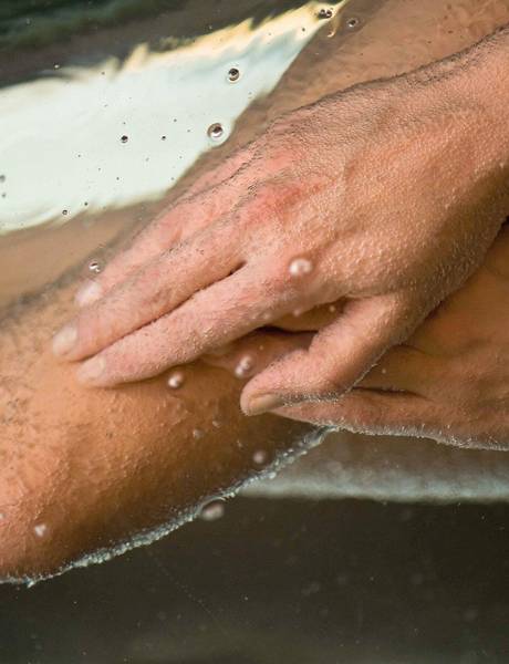 Carbonic acid bath in REDUCE health resort